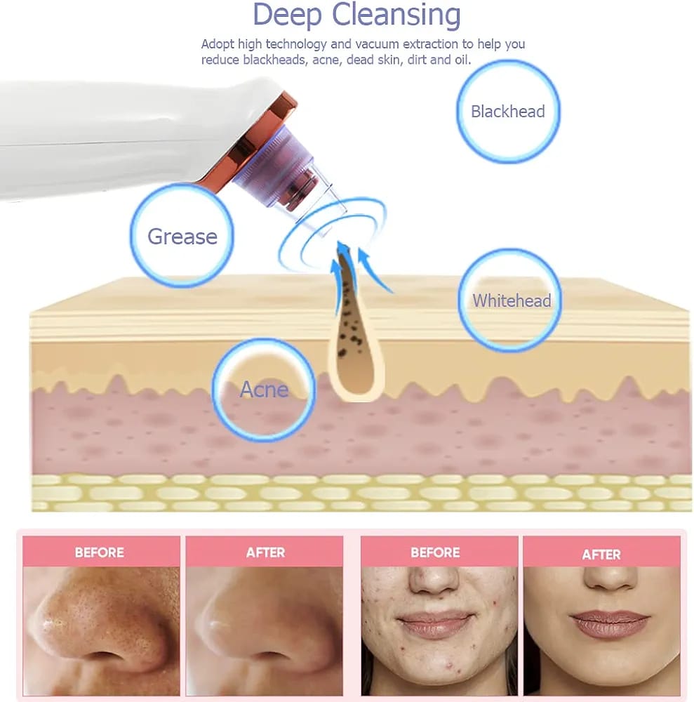 Rechargeable Blackhead Remover Pore Vacuum Cleaner Daweir
